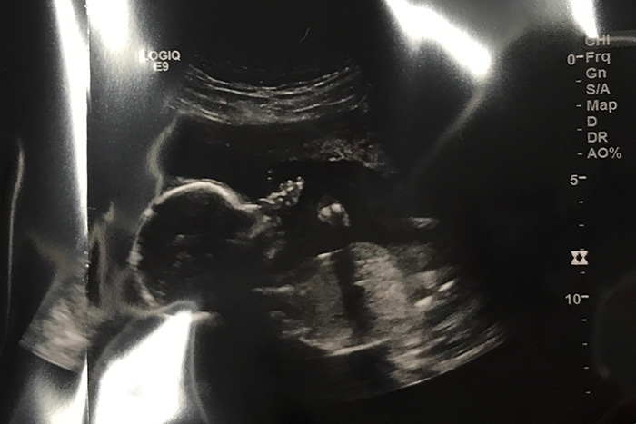 baby martin ultrasound