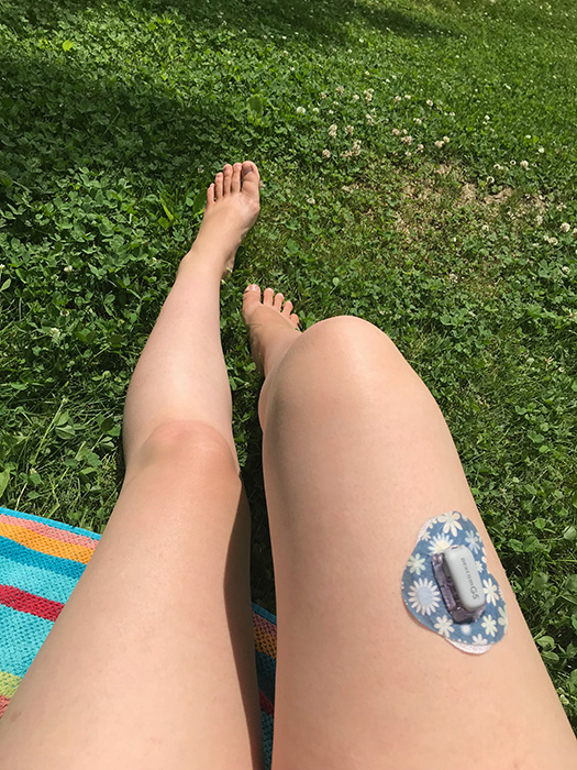 Dexcom on legs with Griff Grips in Summer