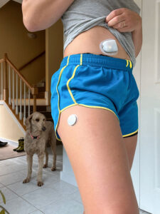 girl wearing shorts showing FreeStyle Libre CGM on leg and lifting up shirt to show Omnipod insulin pump on stomach